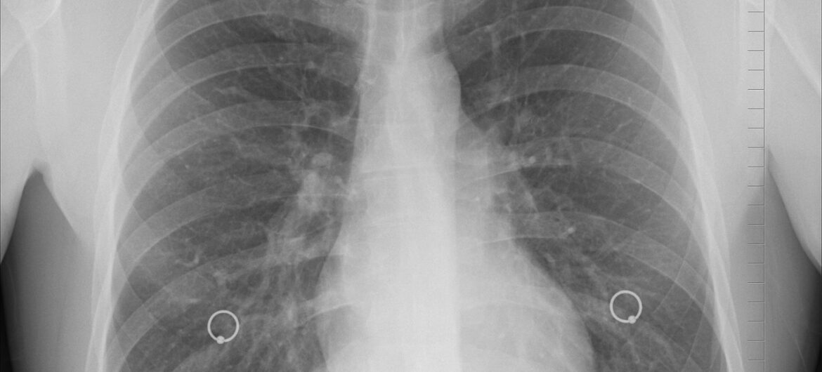 Groźna choroba u nauczycielki. Trzeba będzie przebadać kilkuset uczniów
